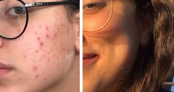 "I noticed changes after 3 days! My pigmentation and spots are completely gone!”