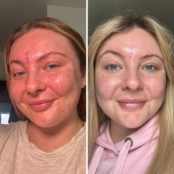 "I noticed redness reduction after 1 week!"