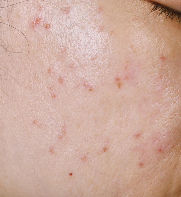 Skin Purging: Why it’s a good thing.