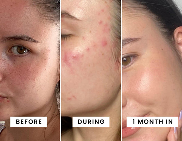 "Purging lasted for 1 week, the results were so worth it!"
