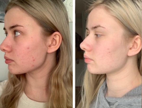 "I have stuck to this routine for a month and all of my scars are almost gone!"