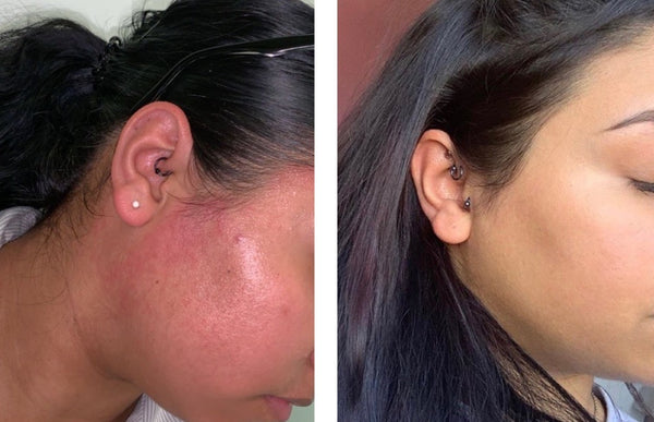 "My skin bumps completely disappeared within 3 weeks of use!"